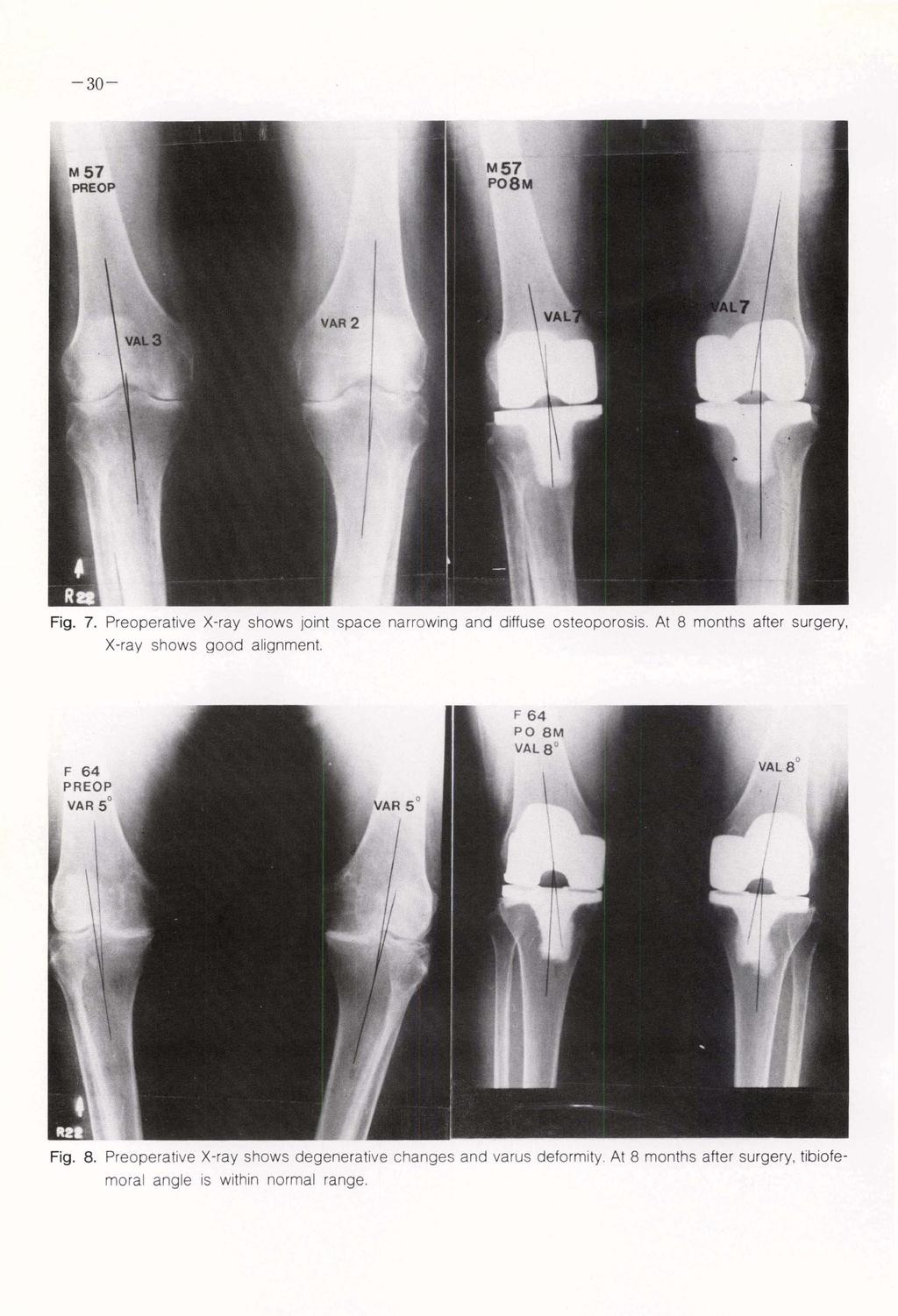 Fig. 7. Preoperative X-ray shows j_ t space narrowing and diffuse osteoporosis. At 8 months after surgery. X-ray shows good alignment. Fig.