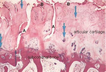 Characteristic histology shows loss of superficial chondrocytes replication and breakdown