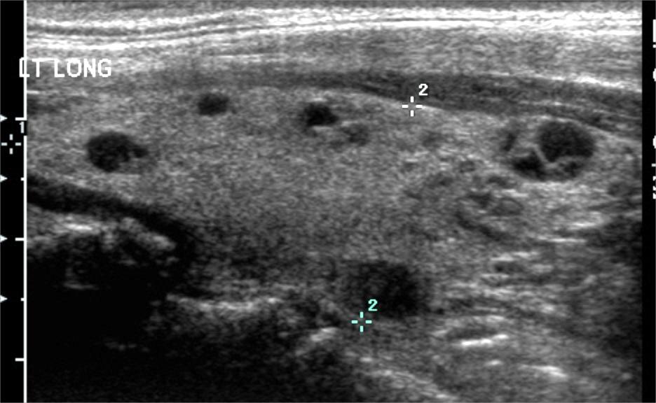 Thyroid Nodules Distribution of # of Nodules Among Cases and Controls Cancer Patients N=96 (%) Control Patients N=369 (%) # of nodules 0 nodule 1 nodule 2 nodules 3 nodules 4 or more nodules Total 3