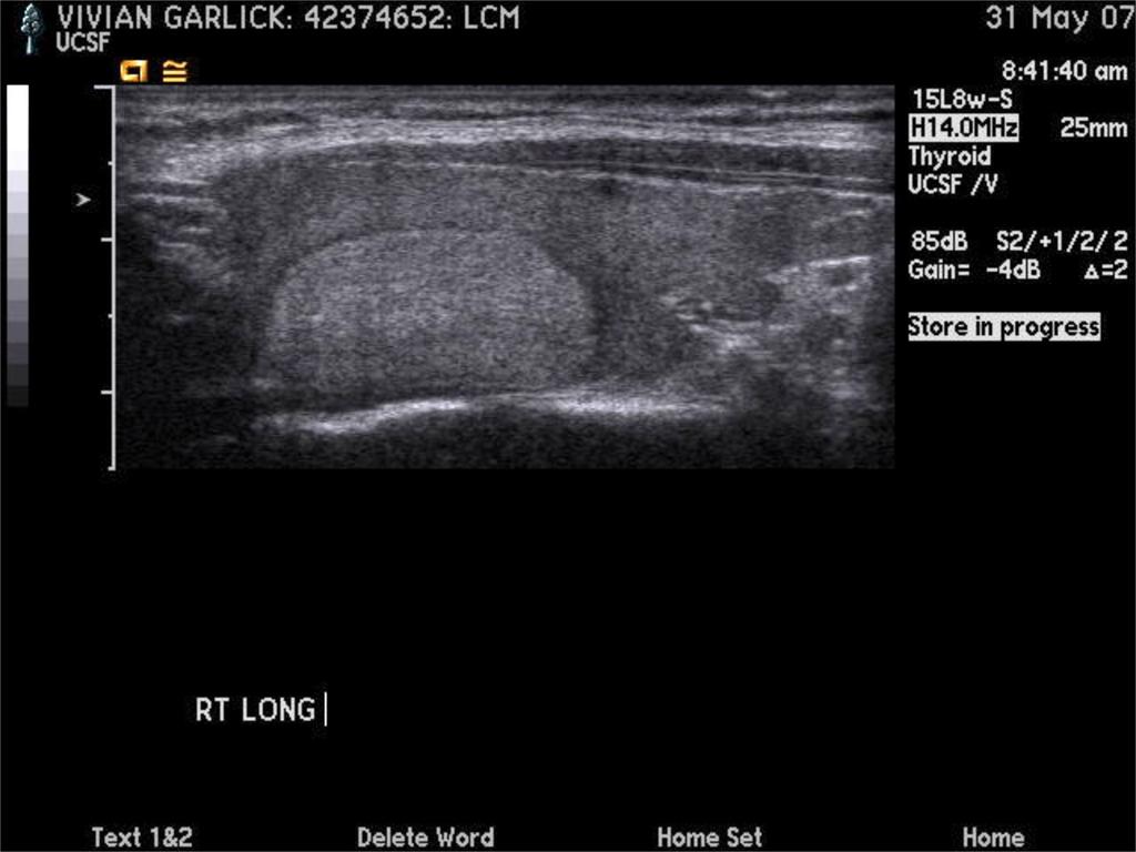 artifact, absence - Rim calcifications - Features Predictive of Malignancy,