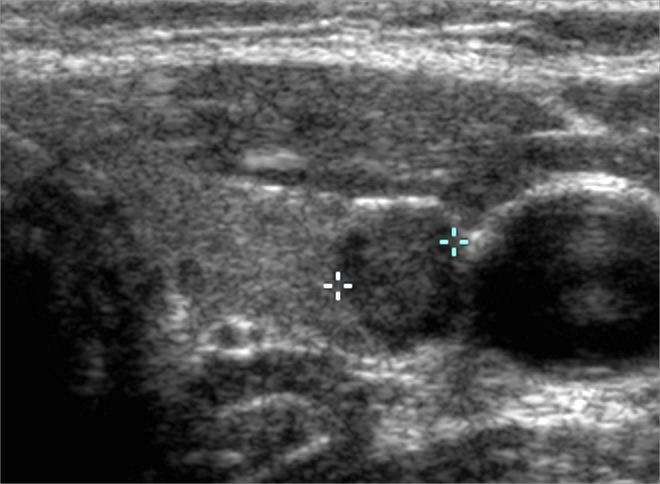 Potential Harm of Too Much Thyroid Ultrasound Patient eventually diagnosed with cancer - missed on initial exam.
