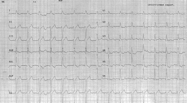 Upper Loop Reentry trial Flutter Figure 1. Twelve-lead ECG during tachycardia with 2:1 ventricular response. lar limb leads was isoelectric or isobiphasic and negative on V 1 (Figure 1).