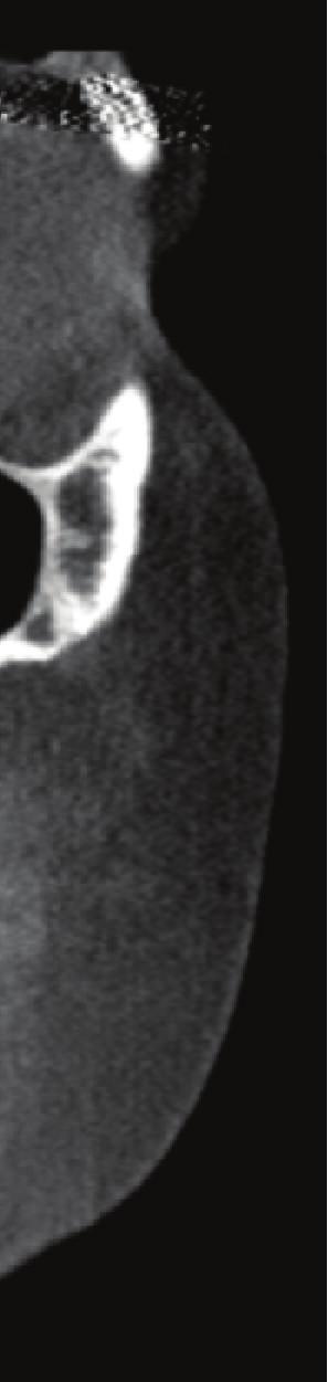 7 Figure 1: Coronal CT scan demonstrating the presence of left middle concha bullosa (arrow). No septal deviation or sinusitis is present.