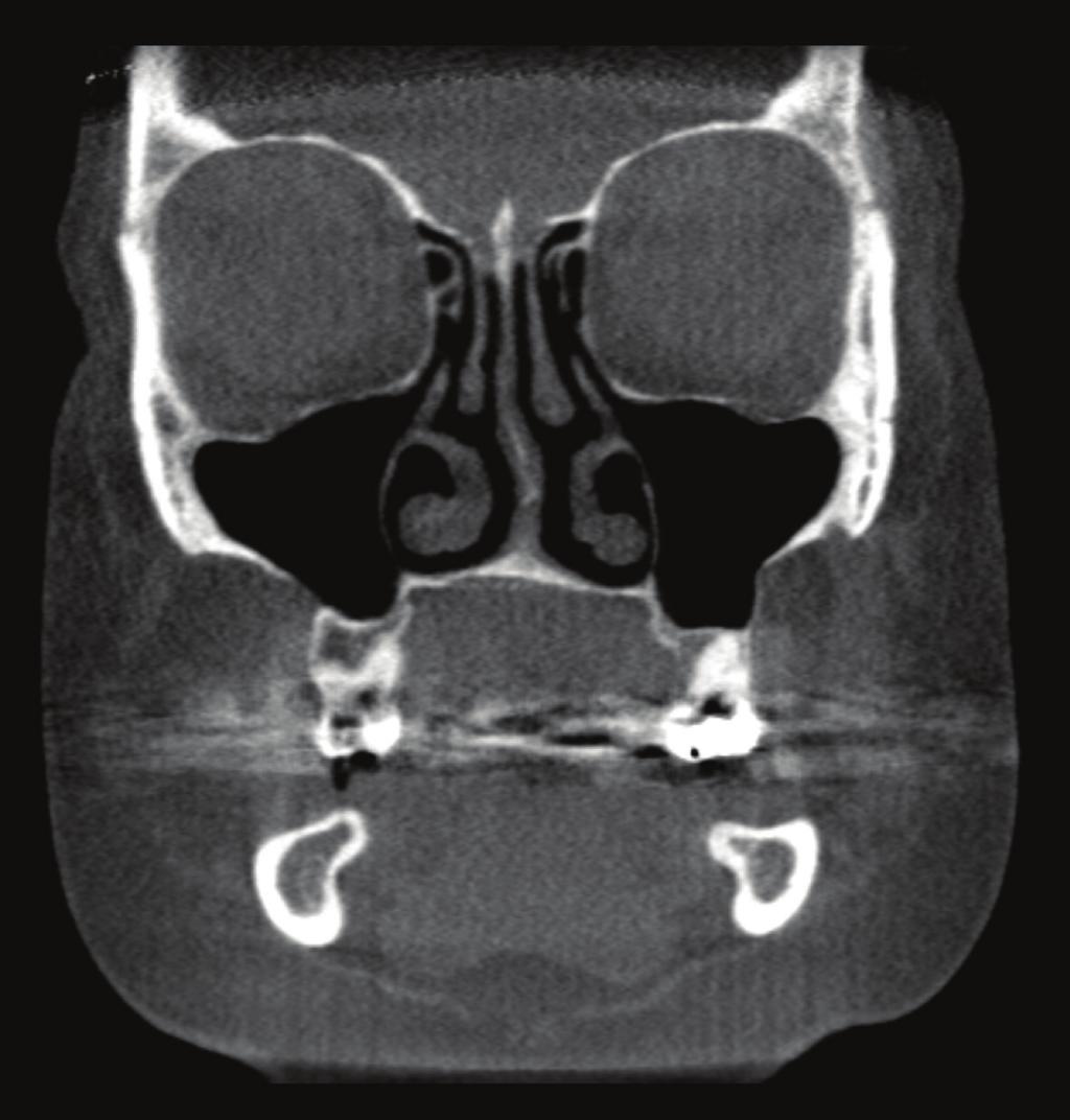 The presence of any radiographic mucosal thickening above the bony floor of the maxillary antrum was defined as abnormal [1, 4]. Data was analyzed with a Chi-square test using the SAS 9.1 program. 3.