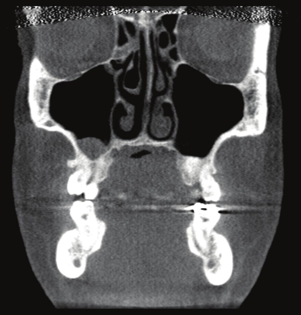 3%) Figure 3: Coronal CT scan demonstrating bilateral maxillary sinusitis (arrows). The degree of sinus inflammation is more prominent in the right sinus.