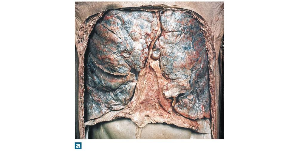 Figure 23-7a The Gross Anatomy of the Lungs Superior lobe RIGHT LUNG Horizontal fissure Middle lobe Oblique fissure Inferior lobe Liver, right lobe Liver, left lobe Thoracic cavity,