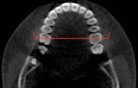 Interdental Distance (ID) From the axial section of the T1 images, at the crown level of the tooth of interest (P1, P2 or M1), an opened-polygon cut was made bucco-lingually so that it passed through