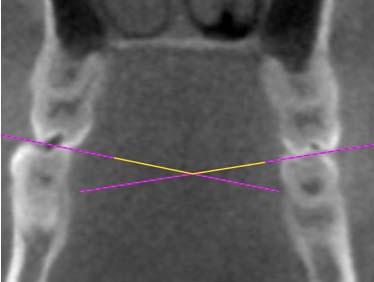 mesiolingual cusp tips of the 1 st molars bilaterally. Figure 9.