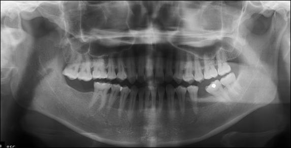 in order to eliminate a maxillary incisor crossbite and to upright the mandibular left second molar before dental implant placement in the adjacent first molar space.
