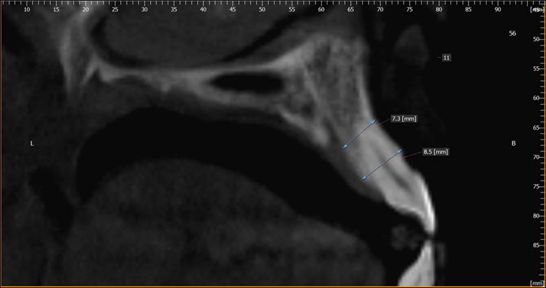 3/10 Figure 3: Pre-treatment cross-sectional CBCT of maxillary right central incisor.