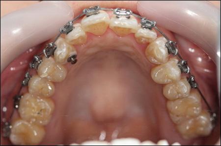 4/10 Figure 4: Intra-oral maxillary and mandibular arches
