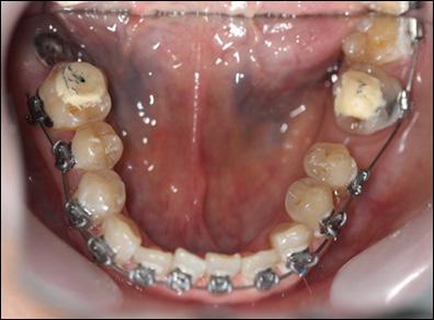 Figure 5: Frontal view immediately after placement of braces on