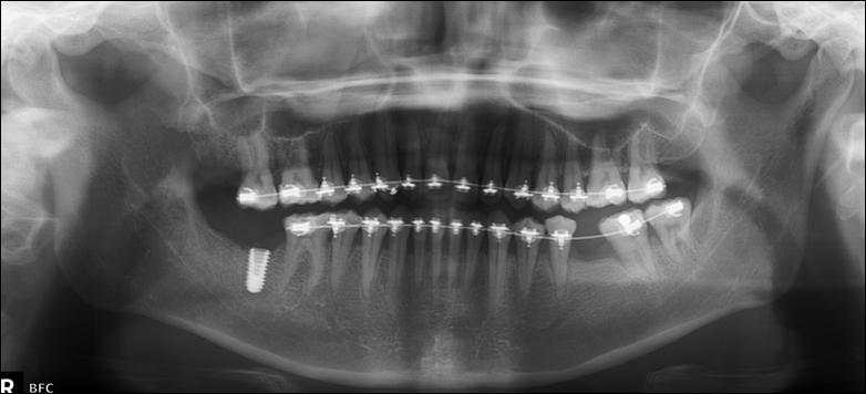 of maxillary first molar extraction site and dental implant fixture