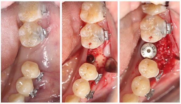 5/10 Figure 7: Hiossen implant placement with guided bone regeneration in mandibular left molar site.