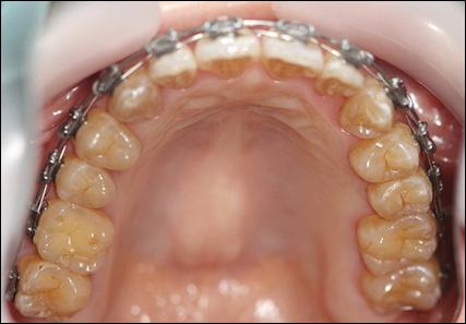 post-treatment show dramatic esthetic and functional improvement, the elimination of maxillary anterior crossbite (Figure 11), expansion of the