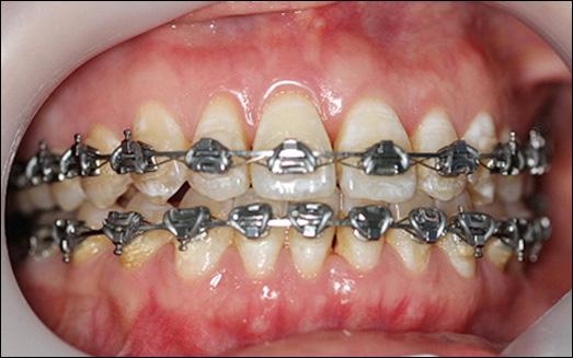 dental implants and correction of anterior guidance with a stable occlusion (Figure 12).