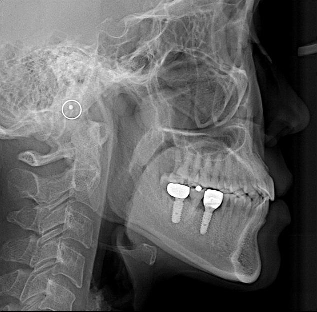 radiographs of mandibular implant