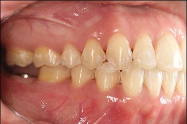 intraoral photographs showing