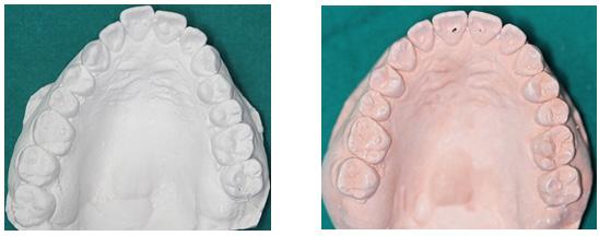 image of maxillary right central