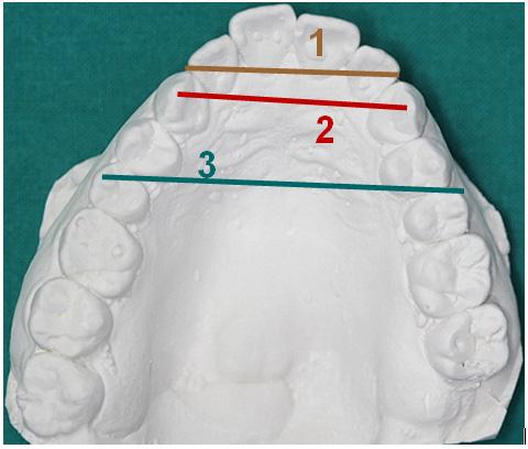9/10 The complex adult dental case requires the expertise and skills of different specialties sequentially planned and executed to insure the best possible outcome for the patient.