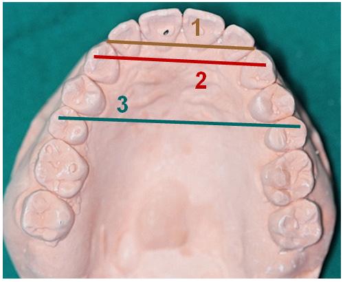 into their correct position while inducing alveolar bone remodeling and development after root movement from the onset of the orthodontic therapy [4].
