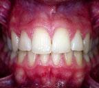 The photos show dental condition right after the esthetic reconstruction