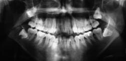 a b Fig 12 (a) Pre- and (b) posttreatment panoramic radiographs reveal that almost no root resorption occurred during the course of the