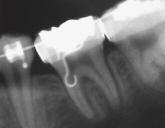 When protraction of the mandibular posterior teeth is intended, though, the DEH enables bodily mesial movement of these teeth, although the protracting speed is significantly reduced (Figs 2b and 2c).