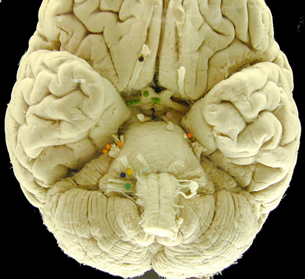 Motor Cranial Nerves III
