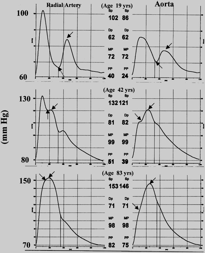 Age-related changes in wave reflection and pressure wave shapes Radial artery (left) and aortic pressure waves (right) in 3 healthy individuals Solid