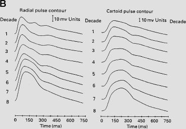 Radial and carotid pressure waveforms Radial (left) and carotid (right) pressure waveforms, plotted as