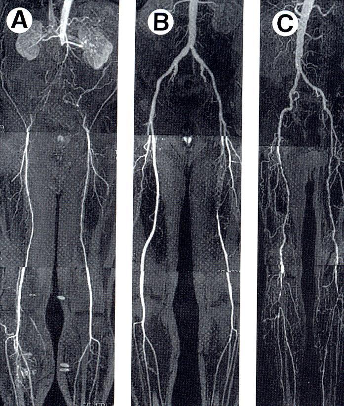 Spectrum of Clinical PVD Claudication: ~20-25% Critical limb ischemia: