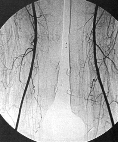 Contrast Angiography The Gold