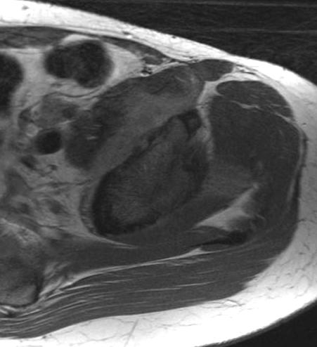 fracture or malignancy Surface coil (shoulder PA;
