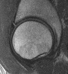 NONCONTRAST MRI OF THE HIP: DIAGNOSTIC ACCURACY HSS study: 92