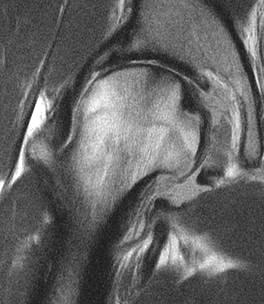 assessing hip cartilage (Dillon et al; ISMRM 2011)