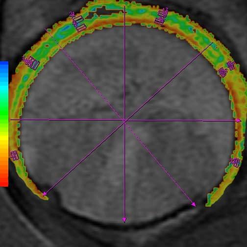 3D CT in FAI patients T2 and T1rho values in and