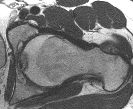 Cam and pincer femoroacetabular impingement: characteristic MR arthrographic findings in 50 patients. Radiology 2006; 240(3):778-85. 3.