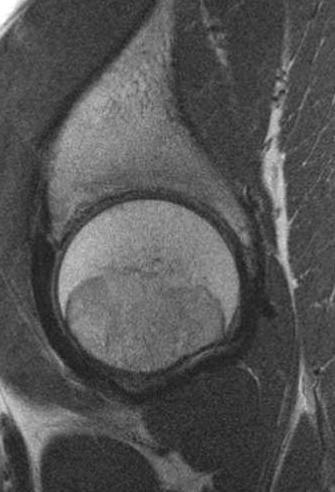 magnetic resonance imaging of cartilage. J Bone Joint Surg 2003;85A:1987-1992 5. Cunningham T, Jessel R, Zurakowski D, Millis MB, Kim YJ.