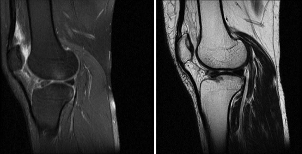 MRI detects bone contusions, marrow changes, and tibial plateau fractures. MRI has unique ability to evaluate internal structure as well as the surface of the ligaments.