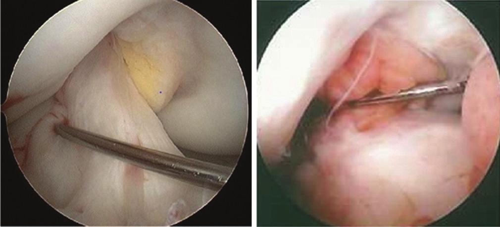 The presence of an intrameniscal high-signal intensity was regarded as a tear, and its grading was done according to whether it reaches to the articular surface or not (Figure 2a and b).