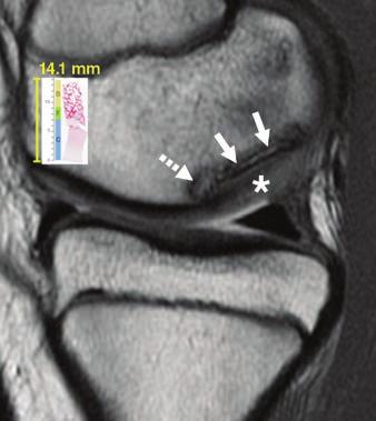 Lateral femoral condyle No. of Biopsies ICRS Classification Surgeon s Description of Stability in Arthroscopy Report Fig.