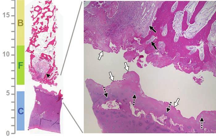 Histopathology-MRI Correlation in Juvenile OCD thologist and a single radiologist chose, by consensus, the most appropriate position of the semitransparent biopsy images with respect to the site of