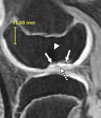 These images are of same patient as Figure 6, but MRI slice shown here is more laterally located within lateral femoral condyle.