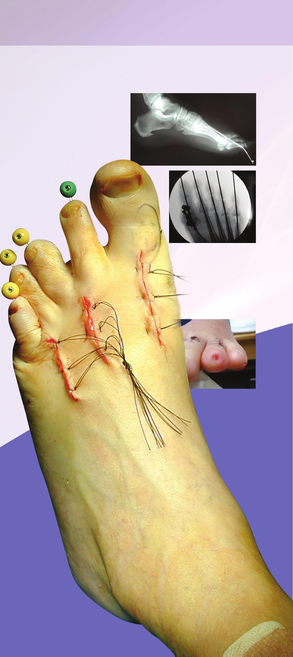 Traditional K-wire treatment involves wires that are exposed at the end of the patient