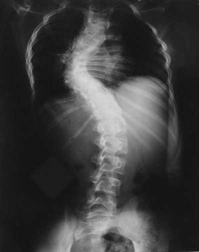 Treatment for scoliosis It is very important to seek medical advice upon realising the child or adult is suffering from scoliosis.