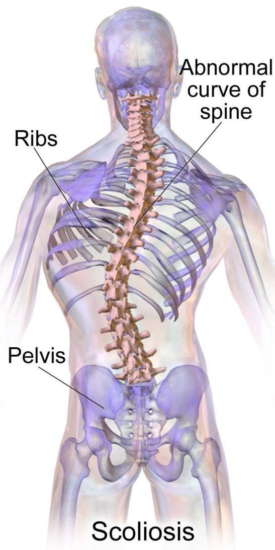 What is scoliosis? Scoliosis is quite simply a lateral curvature in the area of the spine that is normally straight.