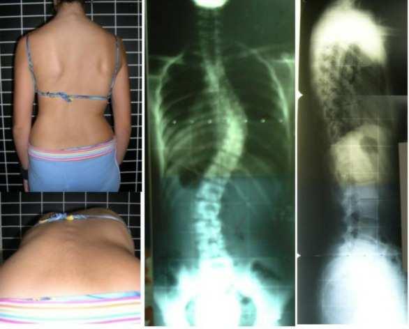 How is scoliosis diagnosed? Most scoliosis curves are initially detected on school screening exams, by a paediatrician or GP, or by a parent.