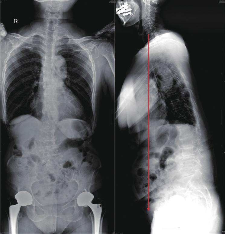Asian Spine Journal Surgical treatment of adult degenerative scoliosis 375 3) Stiffness of curve: In stiff curve it is difficult to achieve optimal correction with surgery.