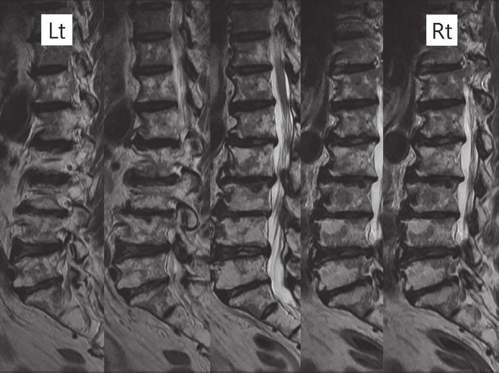 However spontaneous correction is not as promising in adult scoliosis due to the decreased flexibility of the curve associated with degenerative change.